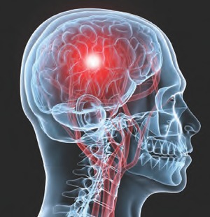 A stroke speculatively caused by an auto collision entitles victim to accident benefits: FSCO Image