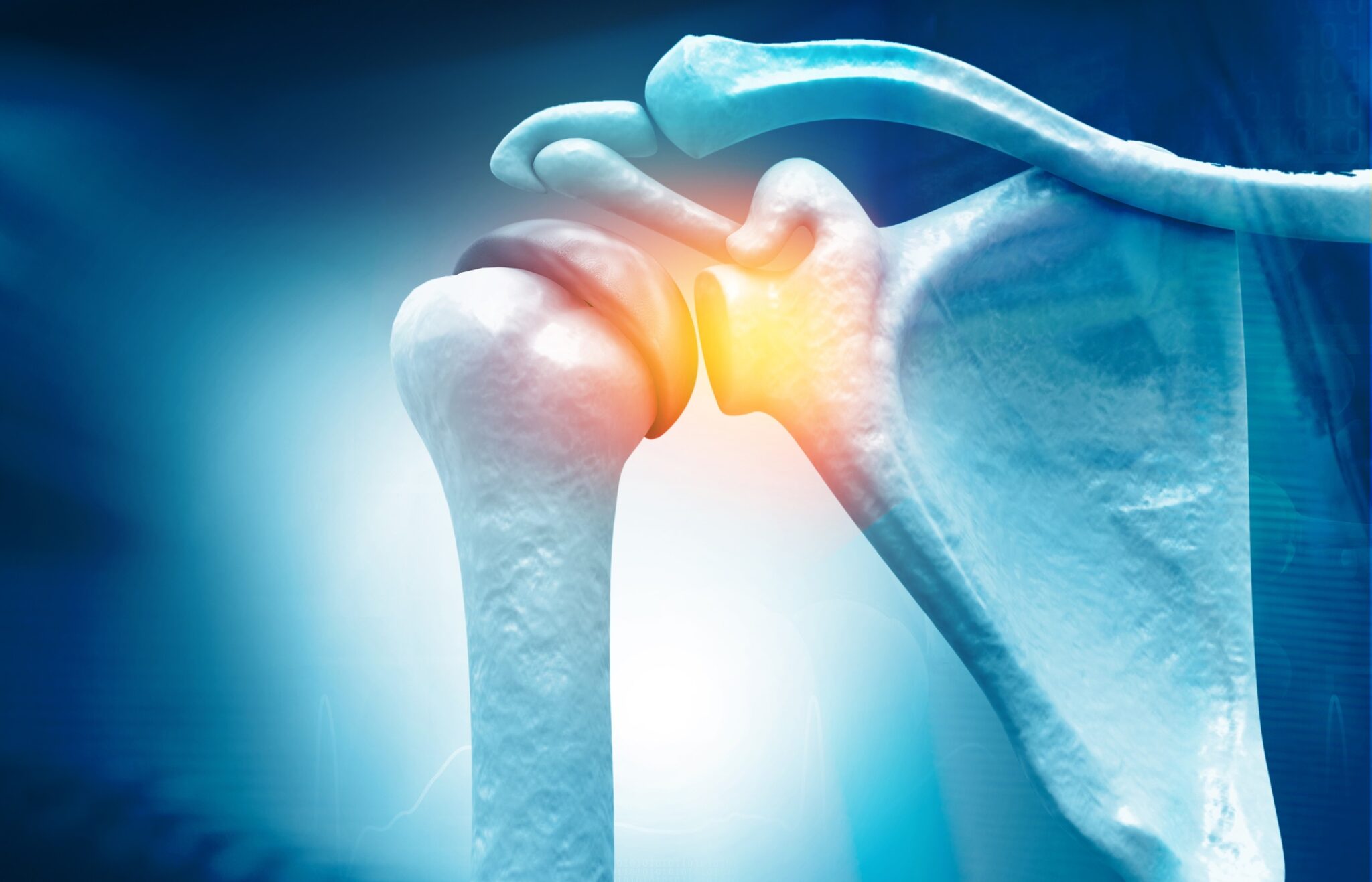 Court upholds minor injury guideline on shoulder tears Image